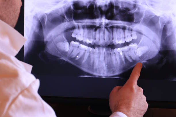 Best Dental Abscess Treatment in Baton Rouge, LA