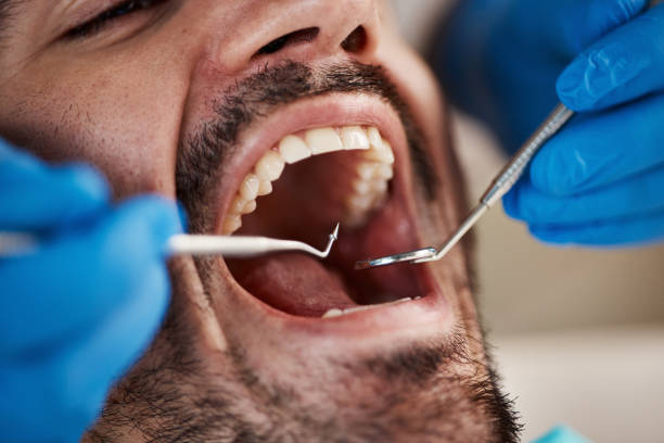 Best Lost Filling or Crown Replacement in Baton Rouge, LA