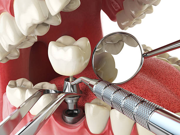 Best Broken or Chipped Tooth Repair in Baton Rouge, LA